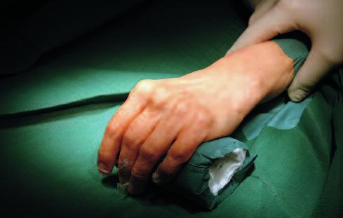 Elogenics Fingerprothese 9 Operationstechnik Hautschnitt und Zugang Der Patient wird in Rückenlage, mit dem Arm auf einem Handtisch, gelagert.