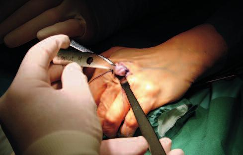 Zur Eröffnung wird die Haut durch eine dorsale Inzision quer, bei einer Operation der MP-Gelenke II V, oder längs, bei nur einem Gelenk, durchtrennt.