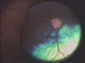 Ophthalsmoskop 2 D 6 D 3