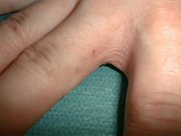 Hautveränderungen mit Rötung, Schuppung, Verdickung und Einrissen im Fingerzwischenraum Wie kommt es zu Hautproblemen?