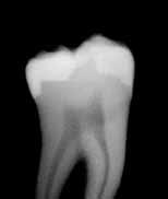 Wissenschaftliche Produktinformation Röntgenopazität II Die eindeutige Sichtbarkeit von Füllungen im Röntgenbild trägt entscheidend zur Erleichterung der Diagnosestellung des Zahnarztes bei.