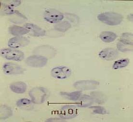 Abb. 3: Infizierte Erythrozyten. Blutausstriche mit intraerythrozythären Ringformen, sog. Trophozoiten, von P. falciparum (links) und mehrkernigem Schizont nach asexueller Teilung von P.