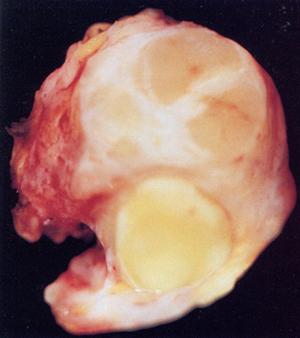 Hodgkin-Lymphom: Pathologie Lymphknotenentnahme