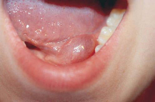 14 Hals-, Nasen- Ohren-Heilkunde 2 Kopfspeicheldrüsen tibiogramm). Bei Mumps kann der Antikörper-Titer serologisch bestimmt werden.