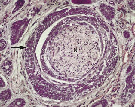 ! Häufigste Primärtumoren bei Tumormetastasen in die Parotis sind spinozelluläre Karzinome (Spinaliome) des Kopfbereichs.