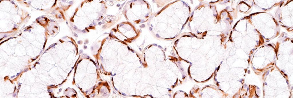 In den Präparaten zeigen die Myoepithelzellen keine Reaktion mit dem Antikörper gegen das S 100-Protein. Als endogene positive Kontrolle fungieren Nervenzellen in den Schnitten. 4.3.1.1.5.
