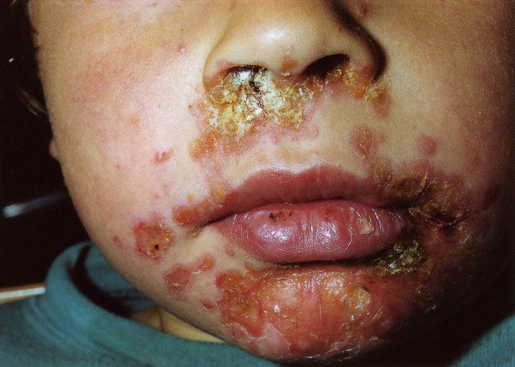 - Impetigo contagiosa (Schmutzflechte) Quelle (Bilder): H j. Cremer. und infektallergische Krankheiten im Kindesalter.