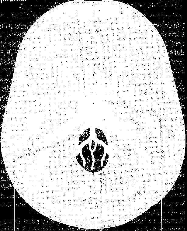 cerebri ant A. carotis interna A.