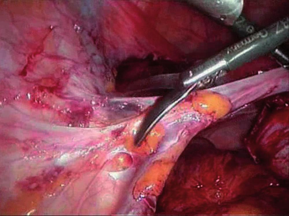 1 Durchführung einer laparoskopischen Transposition mit Verlagerung eines Ovars subdiaphragmal 9.1 9.2 9.3 9.