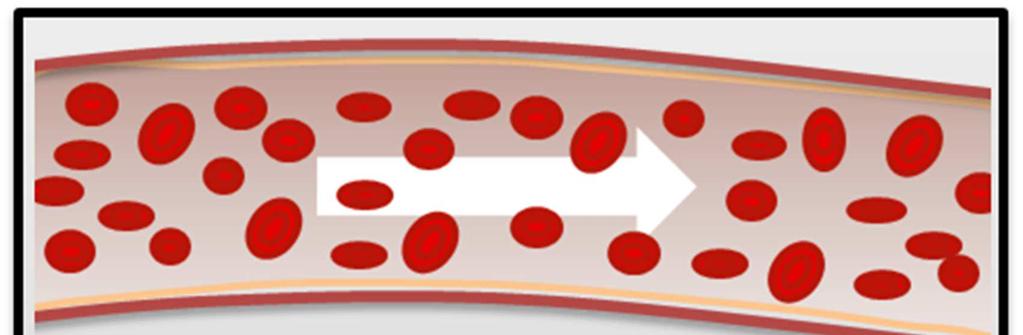 Abbildung 43: Entstehung einer Arterienverkalkung durch Einlagerung von Cholesterin, Fettsäuren und Kalk.