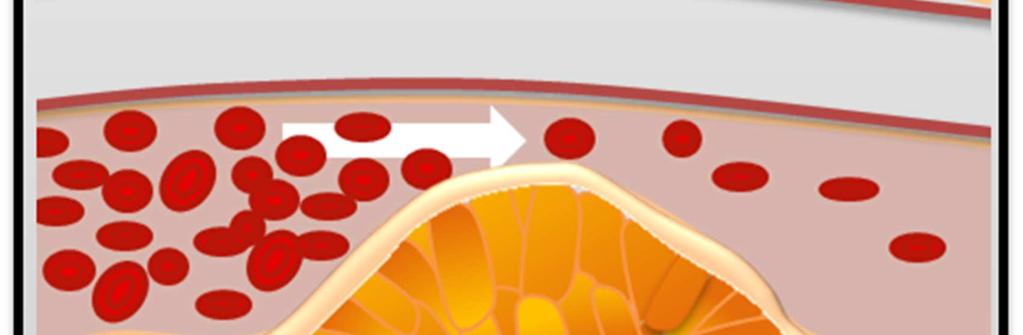 Lipiden, Kohlenhydraten und Nukleinsäuren. Die Oxidation von Lipiden kann in einer Konsequenz zur Arterienverkalkung führen.