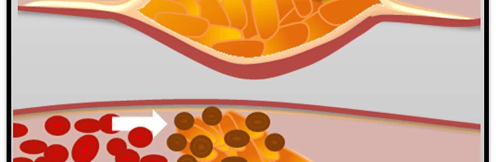 Lipoproteine geringer Dichte) etwa, werden diese von sogenannten Schaumzellen der Blutgefäßzellen aufgenommen und lagern sich dann