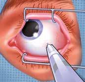 Auf Ihr Gesicht wird ein Operationslaken gelegt. Ihr Auge wird mit einem Speculum offen gehalten. Ihr Arzt wird die Injektion in den weißen Teil Ihres Augapfels vornehmen.
