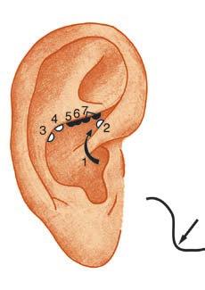2.2 Lokalisation der wichtigsten Ohrreflexpunkte 17 Abb. 2.19 (1) Fasern des Parasympathikus mit Wirkung auf Abdominalorgane, (2) Punkt Omega I (Plexus hypogastricus).