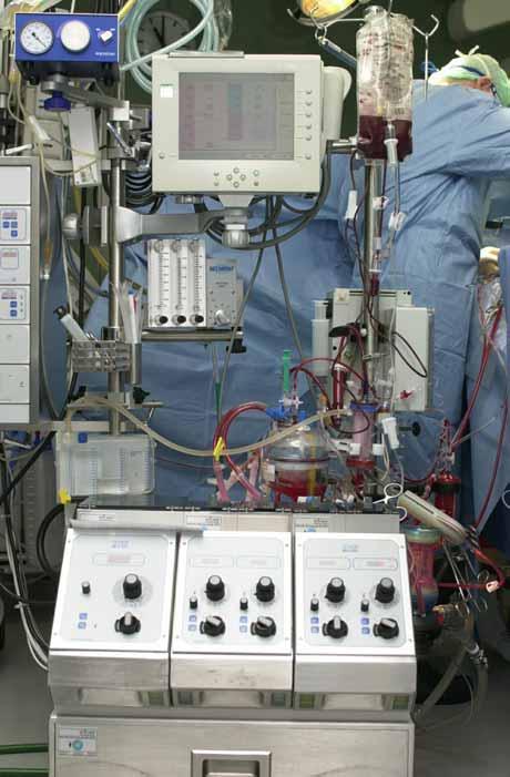 Einsatz der Herz- Lungen-Maschine OP ohne HLM Ductus arteriosus Istmusstenose Perikardektomie Bypass-OP OP mit HLM