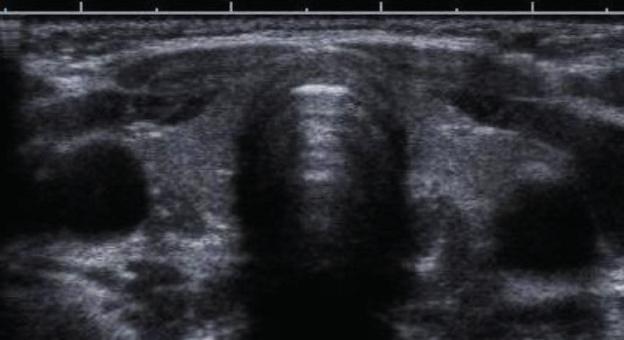 Schilddrüsensonografie Standardschnitte: Axialschnitt über dem Isthmus Querschnitt beider Schilddrüsenlappen in Isthmushöhe. Trachea, M.