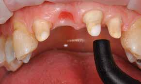 Präparierten Zahnbereich mit Wasser spülen Anschliessend mit Luftbläser und ölfreier Luft trocknen. (Dentin nicht übertrocknen.