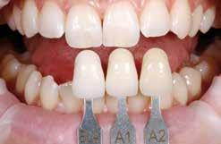 Farbe Zahnfarbe und Abutmentfarbe Nach der Zahnreinigung erfolgt die Bestimmung der Zahnfarbe mittels Farbschlüssel am noch nicht präparierten Zahn bzw. den Nachbarzähnen.