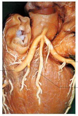Arteria coronaria sinistra linker
