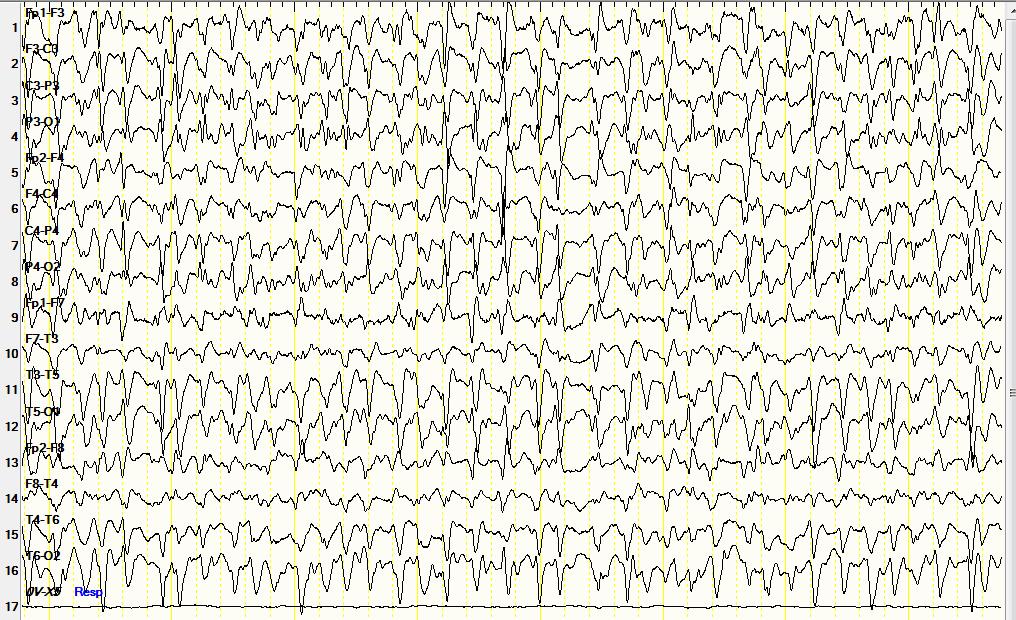 Weiterer ITS-Verlauf EEG-Dauerableitung Antimyoklonische Therapie