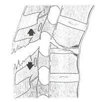 Einleitung A3/Berstungsbrüche: Der Knochen destruiert (,birst ) ganz oder teilweise. Die Hinterkante ist beschädigt.