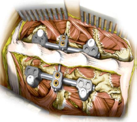Material und Methoden sator extra abzusichern. Als Indikationen gelten unter anderem Magerl-B- und -C- Verletzungen sowie Brüche an der hinteren Säule. Abb.