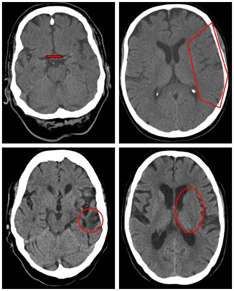 Patienten und Methoden 18 Abb. 6: Darstellung der CT-Infarktfrühzeichen: oben links: Zeichen der hyperdensen A.