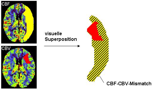 Patienten und Methoden 26 und der CBV-Erniedrigung. Im Falle einer Größendifferenz zu Gunsten des CBF wurde der visuelle Befund als CBF-CBV-Mismatch klassifiziert (siehe Abb.