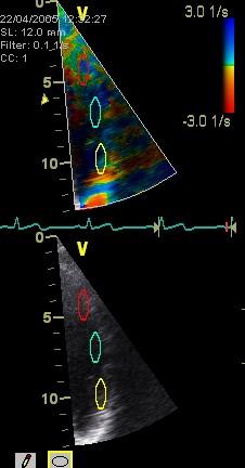 Die Länge einer ROI betrug bei dieser Messung 3-5mm, wiederum abhängig von der Herzgröße (Abb. 3.8) Apex RV-Wand Sept LV-Hinterwand Aorta Mitralklappe LV-Messpunkt Septum-Messpunkt Abbildung 3.