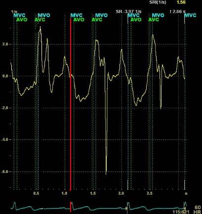 am Anfang der drei zu analysierenden Herzzyklen; Abbildung links unten: Zeitbalken im Verlauf des Tissue Trackings; Abbildung rechts
