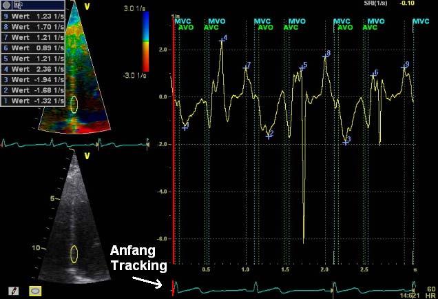 14: Strain Rate-Kurve basales Septum mit Messungen vor dem Tissue Tracking Wert in 1/s 9 1,30 8 1,38 7 1,12 6 3.