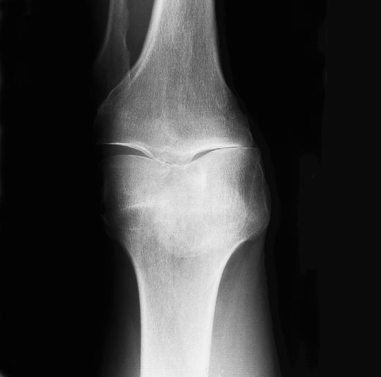 Wissenswertes zur Operation Das gesunde Kniegelenk wird aus der Gelenkfläche des Oberschenkels und der des Unterschenkels gebildet.