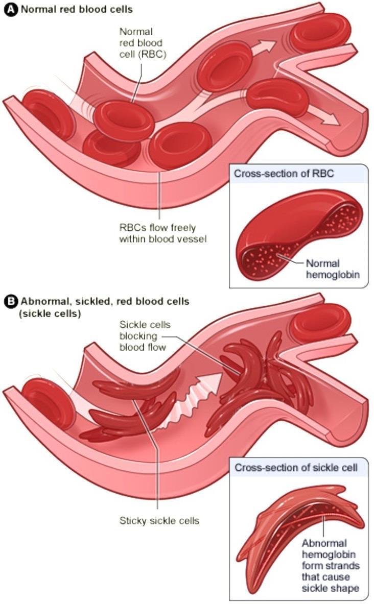 Hb Mutation #1: Sichelzellanämie Sichezellhämoglobin