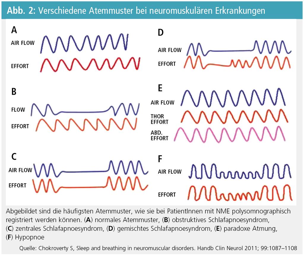 Kardiorespiratorische Polysomnographie EEG EOG EMG Atmung oronasal thorakal