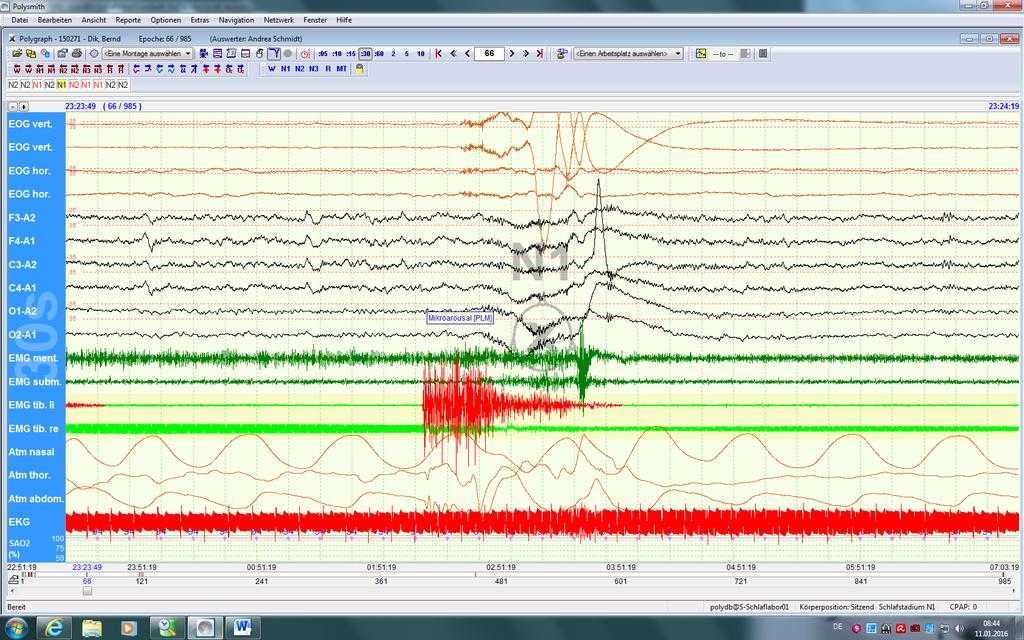 periodische Beinbewegungen Kardiorespiratorische Polysomnographie EEG EOG EMG Atmung EKG oronasal
