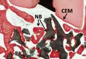 Die histologische Untersuchung zeigte eine vollständige Überbrückung des Osteotomiekanales nach drei Monaten sowie einen gut entwickelten neuen Knochen (NB) und Zahnzementbildung