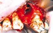 Insertion von zwei Implantaten