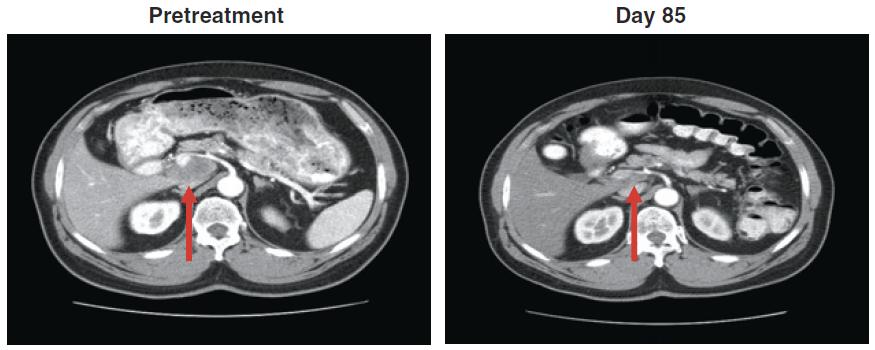 Durable Cancer Regression Off-Treatment and Effective Reinduction Therapy with an Anti-PD-1 Antibody in MSI high + PD1L pos. mcrc.