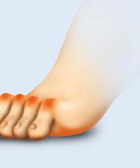 Beinachse vor. Eine abgeflachte mediale Fußwölbung geht oft mit einem Genu valgum einher.
