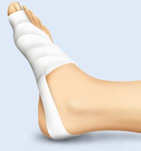 3.13 Veränderungen der Fußstatik Therapie Konservativ Um den Krankheitsprozess aufzuhalten, werden nachts Hallux-valgus-Lagerungsschienen eingesetzt oder ein Tapeverband angelegt ( Abb. 3.108a b).