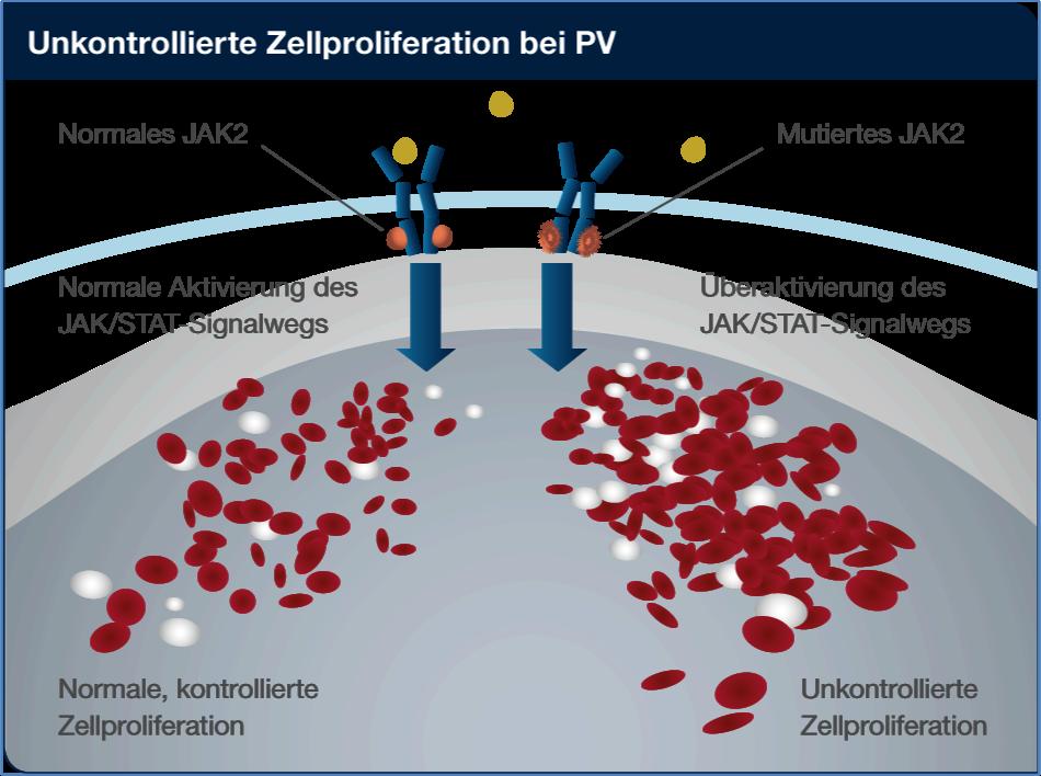 Ursache der PV: Überaktivität der Januskinase 2 Bei der Mehrzahl von Patienten mit Polycythaemia vera liegt eine Punktmutation im Gen der Januskinase(JAK)2 vor.