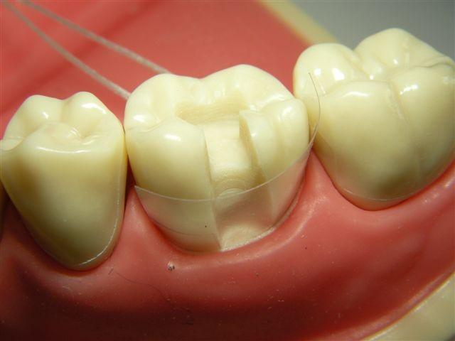 Anwendungsbeispiel der neuen Dentalmatrize mit Führungsfaden: Auch in diesem Fall kann die neue Dentalmatrize leichter eingeführt und durch das Ligieren fixiert werden.