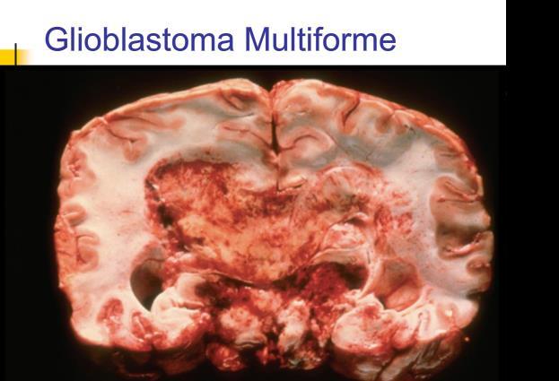 Glioblastoma Multiforme (bevorzugt im 50.- 60.