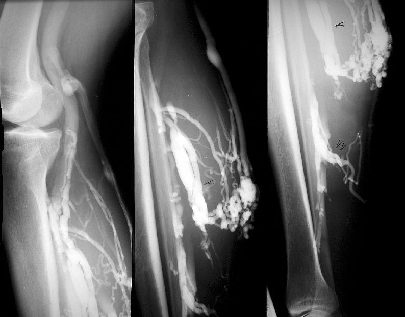 Über eine May-Perforans füllt sich 15 cm unterhalb des Kniegelenkes eine breit-variköse Verbindung zur degenerativ veränderten medialen GC-Muskelvene ( ).