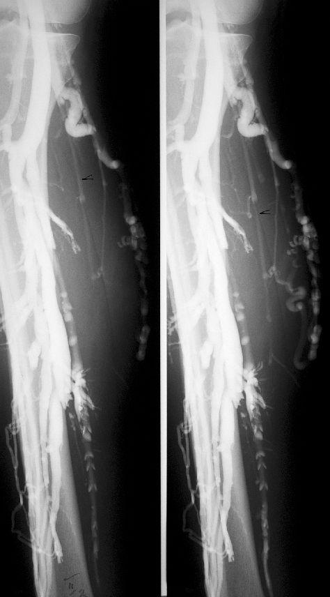 268 Beispiele: /) In der aszendierenden Pressphlebographie () unter Valsalva Reflux mit Saphena parva-stammbelastung bis 5 cm unterhalb des Kniegelenkes.