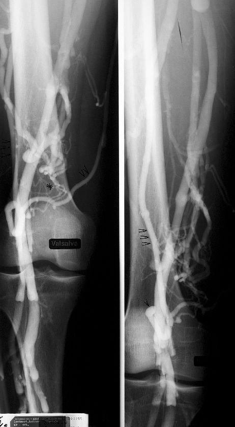 aneurysmatischer Erweiterung 5 cm oberhalb des Kniegelenkspalts. Ab Gelenkhöhe setzt sich die V. femoropoplitea mit Zufluss zur V.