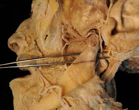 9 tief: Mit einem sagittal geführten Sägeschnitt das Kiefergelenk eröffnen.