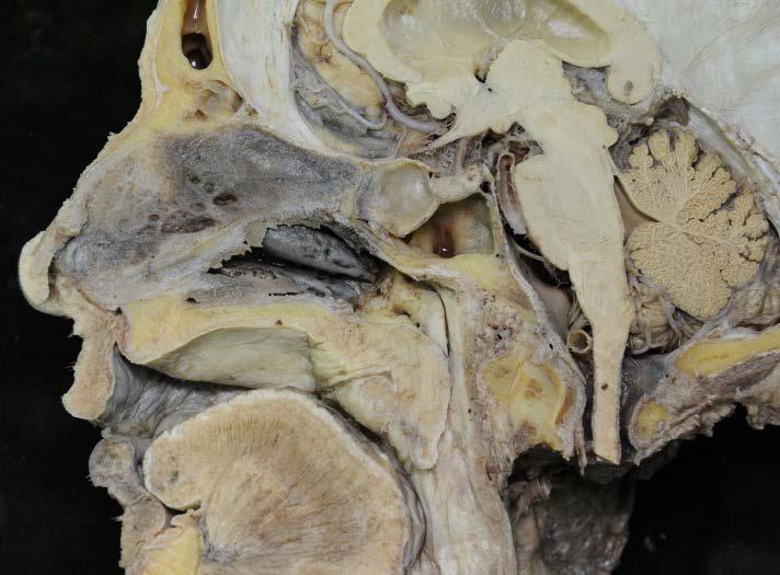 Ganglion pterygopalatinum oberflächlich: Reste der Nasenscheidewand (Markierung,