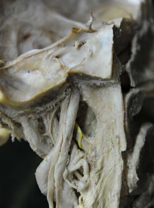 Parapharyngealraum 7 tief: Dorsale Pharynxwand () bis zur Schädelbasis freilegen, die Membrana pharyngobasilaris und die Pharynxmuskulatur darstellen. M. stylopharyngeus () und den N.