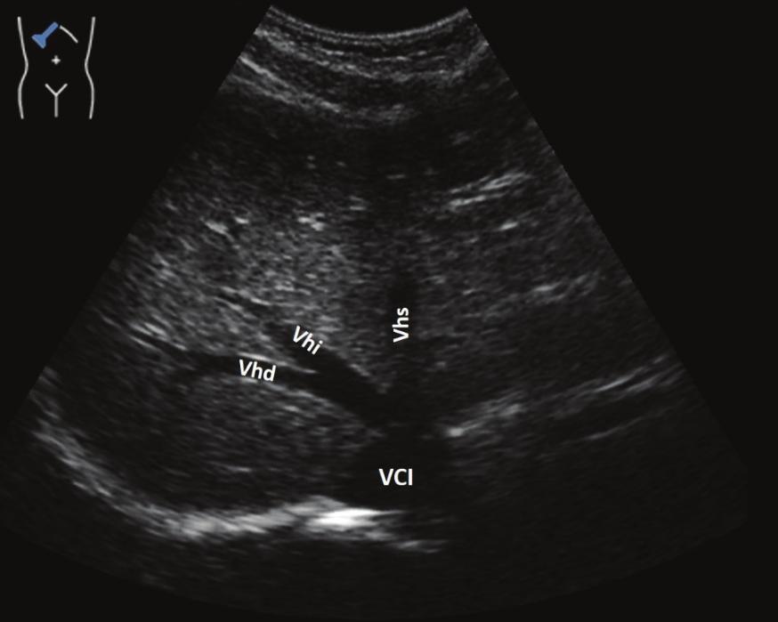 Abbildung 28: Mündung der Venae hepaticae dextra (Vhd), intermedia (Vhi) und sinistra (Vhs) in die Vena cava inferior (VCI).